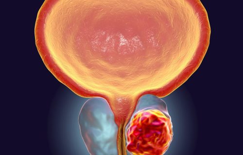 Cáncer de próstata
