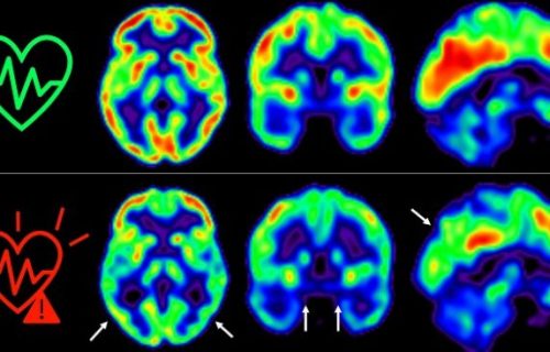 cerebro